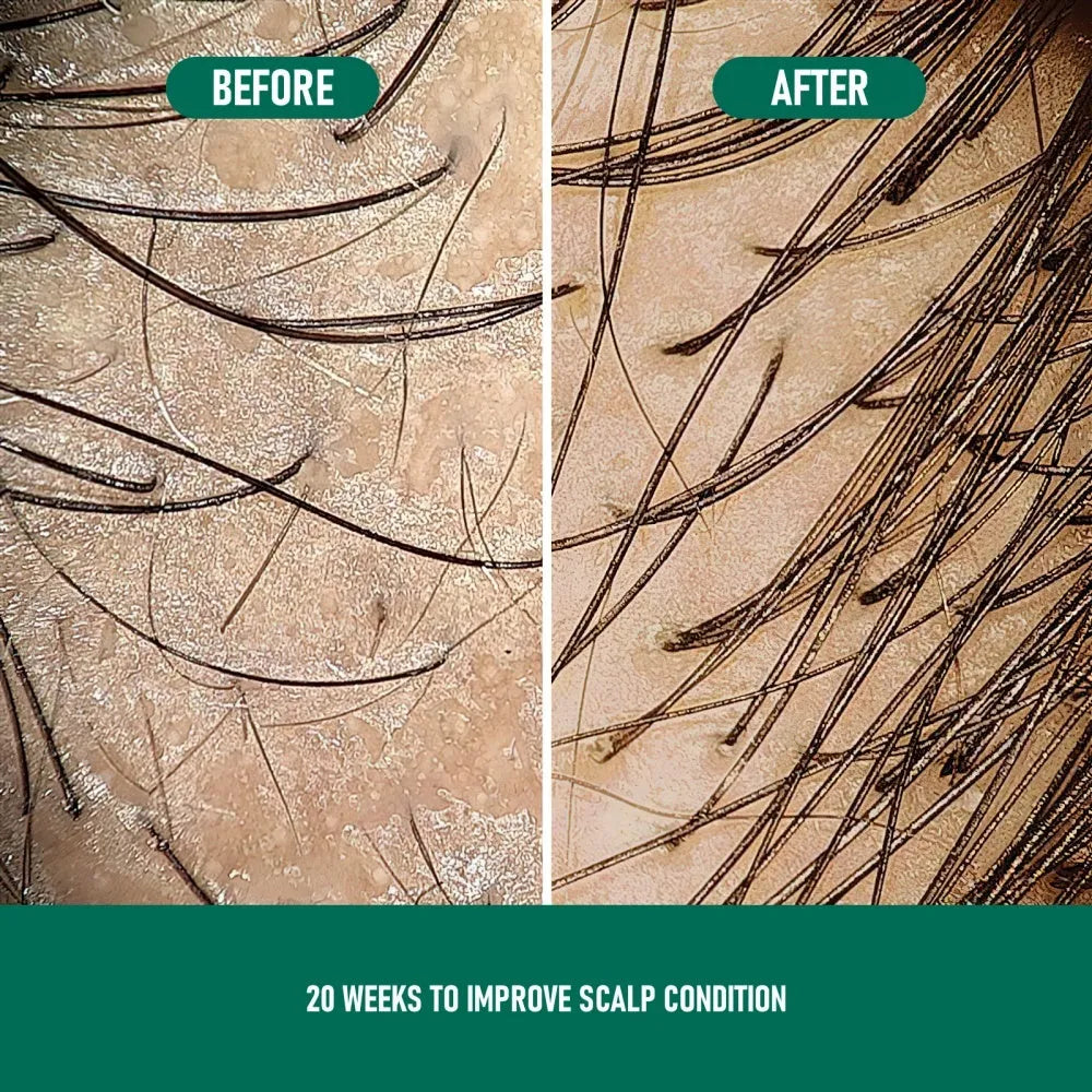 CH004 60ml bottle of 5% minoxidil anti-hair loss treatment mousse foam