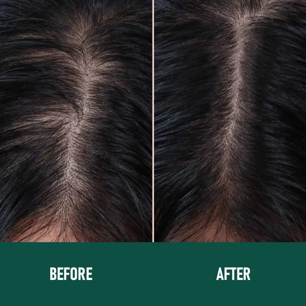 CH004 60ml bottle of 5% minoxidil anti-hair loss treatment mousse foam