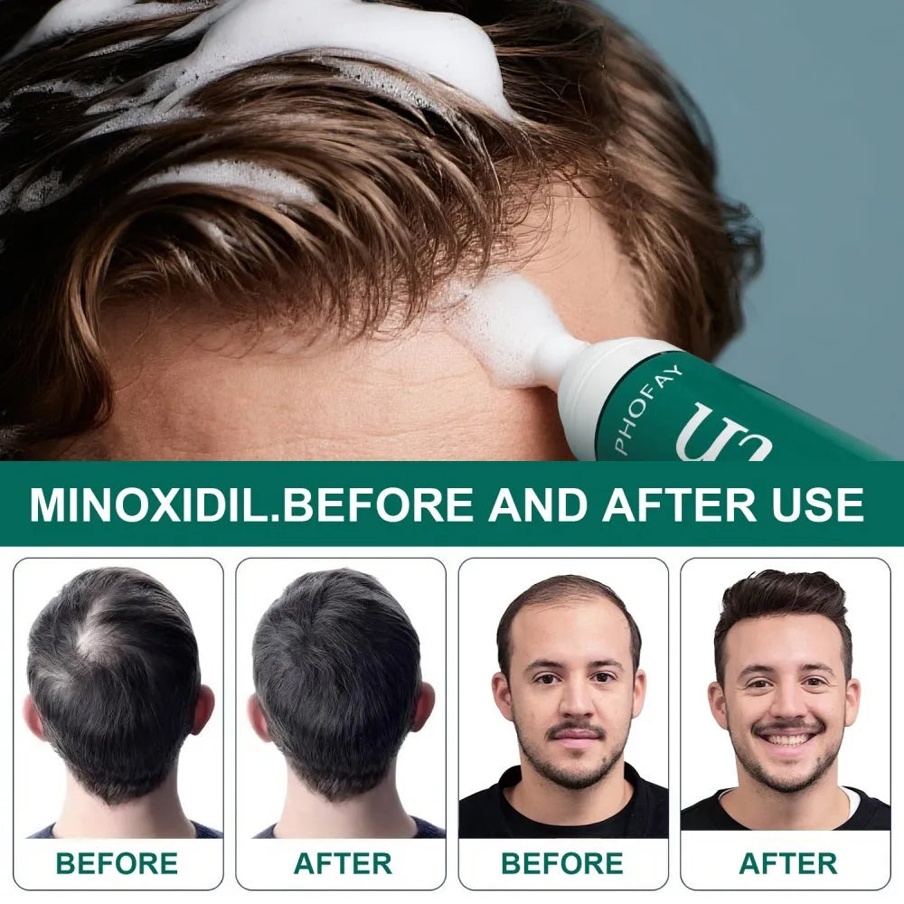CH004 60ml bottle of 5% minoxidil anti-hair loss treatment mousse foam