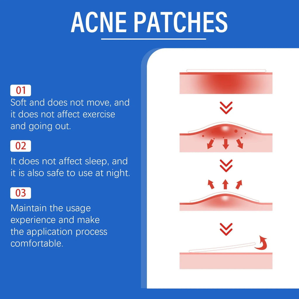 216-count acne patches with tea tree oil and vitamin E for gentle facial spot treatment